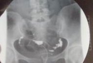 子宫腺肌症对试管婴儿有影响吗？